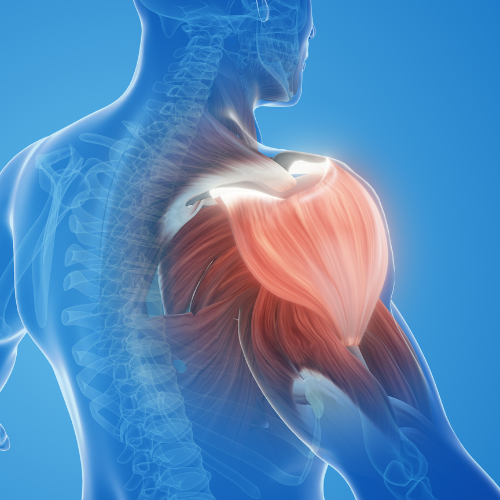 Shoulder pain while lifting your arm caused by rotator cuff tear